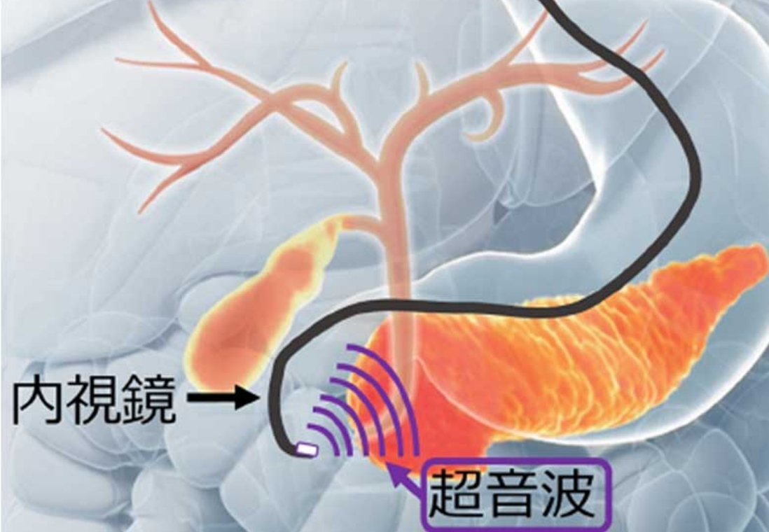 超音波内視鏡(Endoscopic Ultrasonography: EUS)